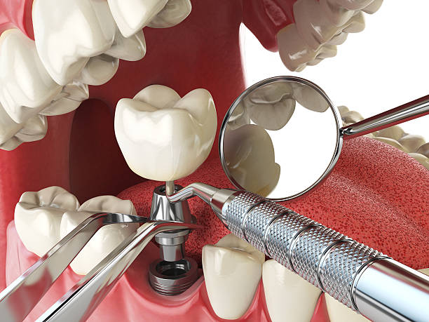 Best Lost Filling or Crown Replacement in Lakeway, TX